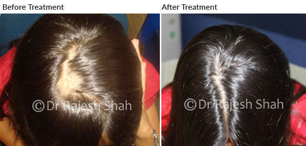 alopecia areata patch after treatment