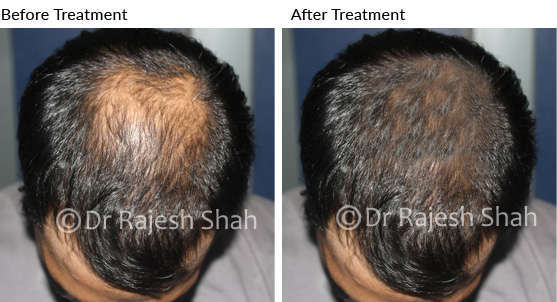 Alopecia before after treatment