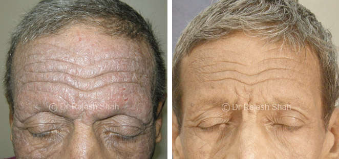 atopic  dermatitis on face