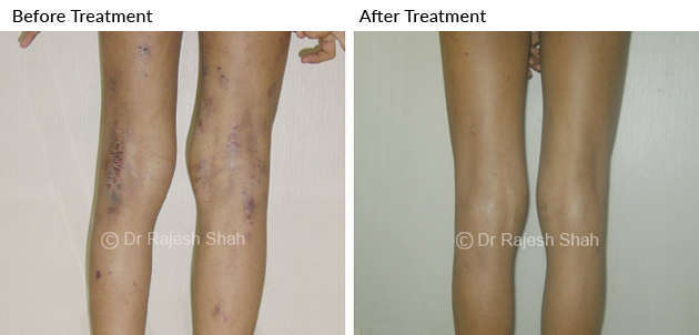 atopic dermatitis on legs