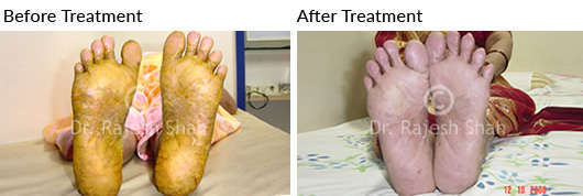 psoriasis on soles of feet