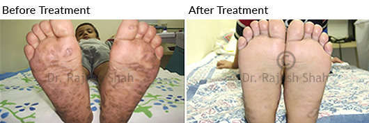 psoriasis on soles of feet