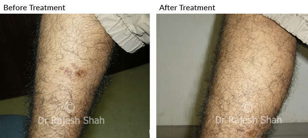 Warts on Legs treated with homeopathy