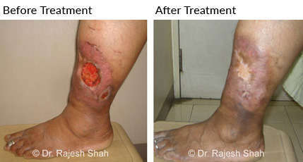 Non healing ulcer in leg was treated with homeopathic medicines