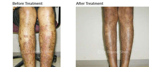 photos of psoriasis on legs