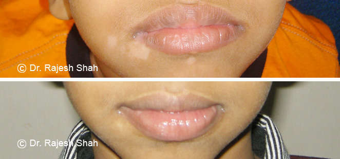 vitiligo on mouth