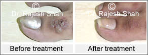 Before after treatment photo of Warts on right foot dorsum