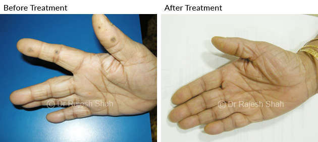 Warts in palm before and after treatment photo