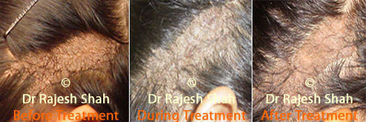 Before After Treatment Photo of Warts on Scalp