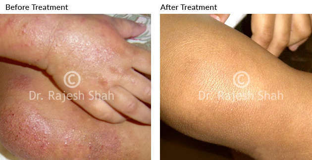 Treatment for Eczema on Legs, before and after treatment photo