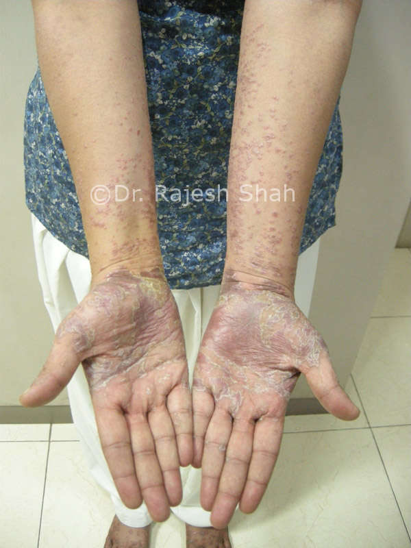lichen planus and psoriasis in palms
