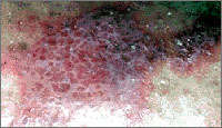 lichen planus skin picture