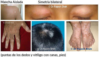 conveniencia Volver a llamar micro Los síntomas de Vitiligo, ¿Cómo se contagia?