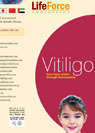 Download Vitiligo brochures