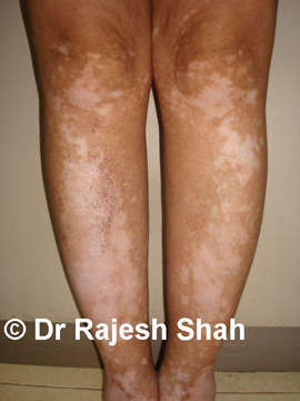 Vitiligo on legs before and after treatment photo