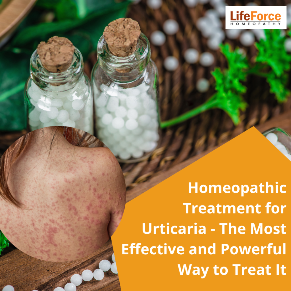 Homeopathic Treatment for Urticaria – The Most Effective and Powerful Way to Treat It