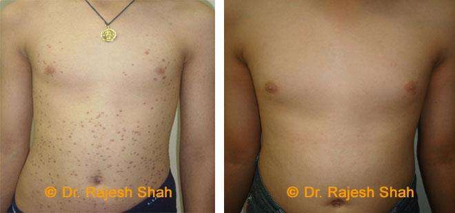 The Homeopathic Way Of Treatment For Lichen Planus