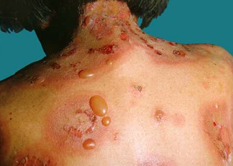 pemphigus