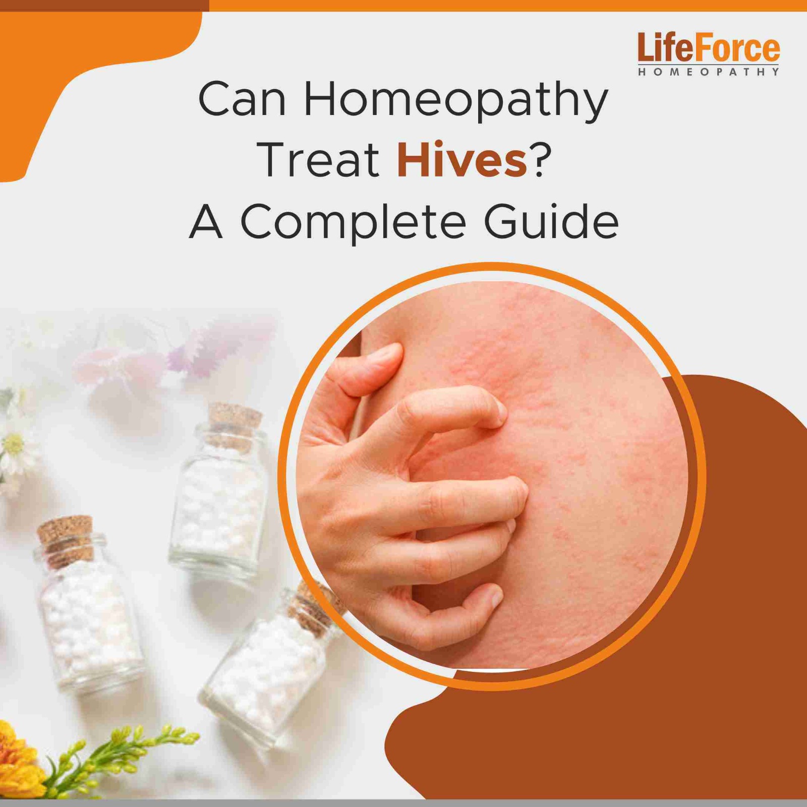 Can Homeopathy Treat Hives? A Complete Guide