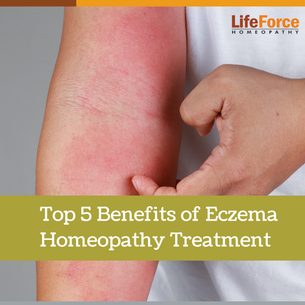 Top 5 Benefits of Eczema Homeopathy Treatment and Medicine for Eczema