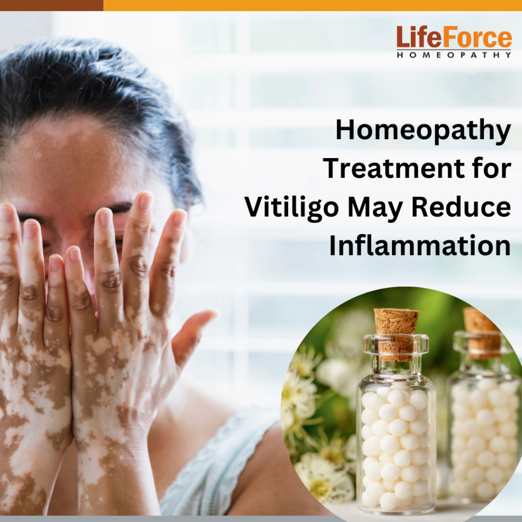Homeopathy Treatment for Vitiligo May Reduce Inflammation Naturally