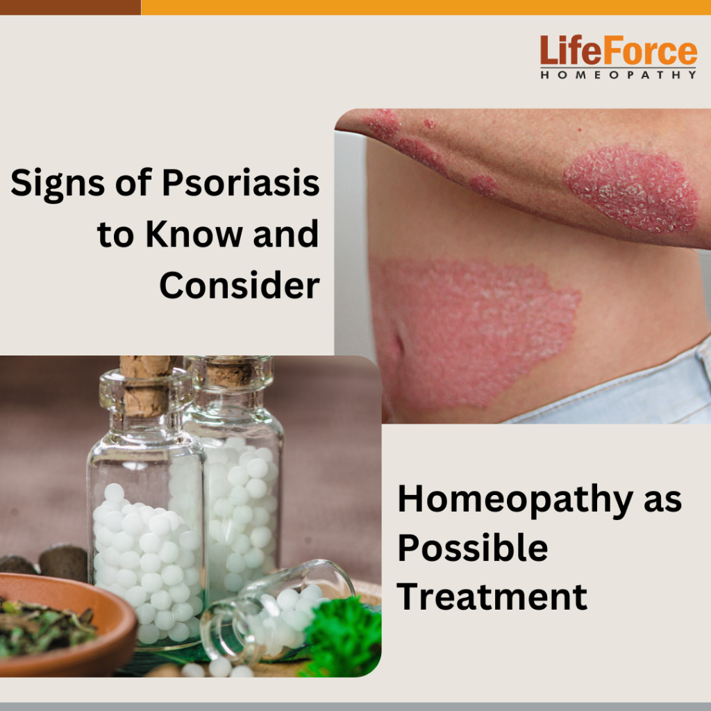 Signs of Psoriasis to Know and Consider Homeopathy as a Possible Treatment