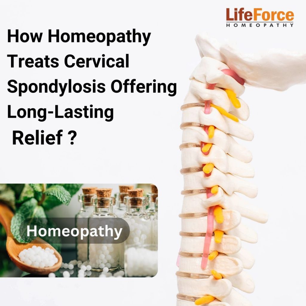 How Homeopathy Treats Cervical Spondylosis Safely Offering Long-Lasting Relief?