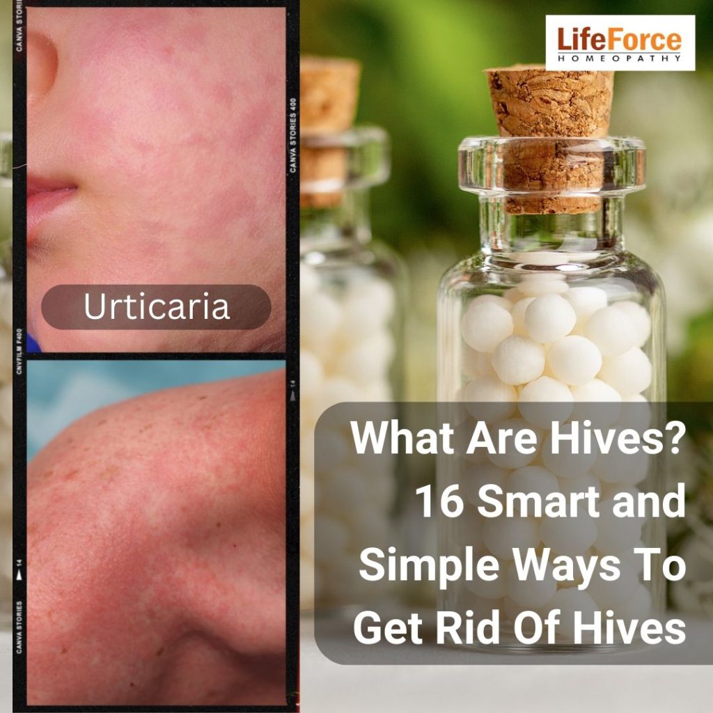 What Are Hives? 16 Smart and Simple Ways To Get Rid Of Hives