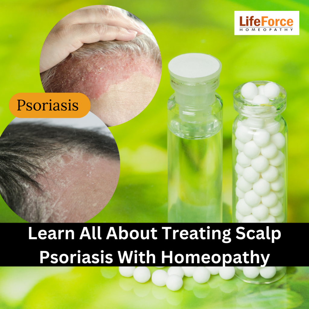 Learn All About Treating Scalp Psoriasis With Homeopathy