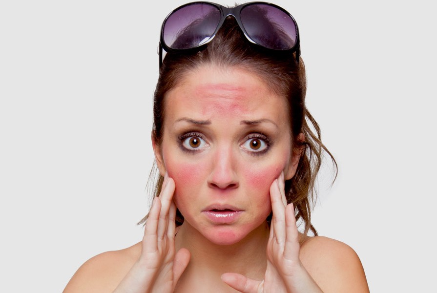 6 Ways To Avoid Sunburn In This Hot Weather