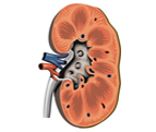 Homeopathic Medicines for Kidney stones