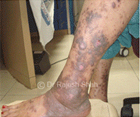 Is cortisone really helpful in treating Lichen Planus?