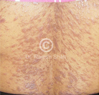 Which cases of Lichen Planus are easy to treat and which are difficult?