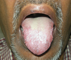 Signs you may have Oral Lichen Planus