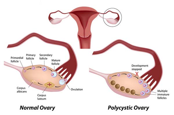 Signs That Your PCOS Is Getting Reversed