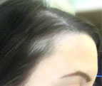 How To Prevent Traction Alopecia