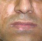 Which cases of Vitiligo are easy to treat and which are difficult?