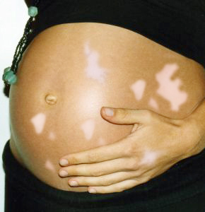 Vitiligo during pregnancy
