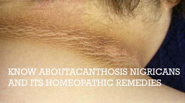 Get To Know About Acanthosis Nigricans And Its Homeopathic Remedies