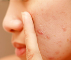 What is Acne Rosacea?