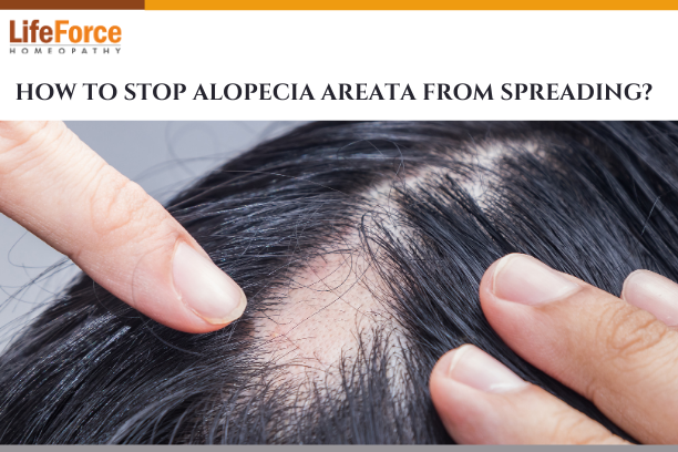 How to Stop Alopecia Areata from Spreading? | Homeopathic Treatment and  Symptoms