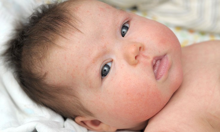 how to tell the difference between eczema and baby acne