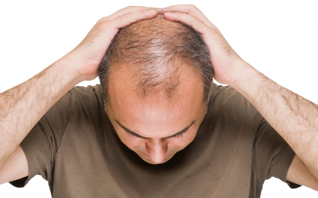 What Are The Reasons Behind My Baldness?