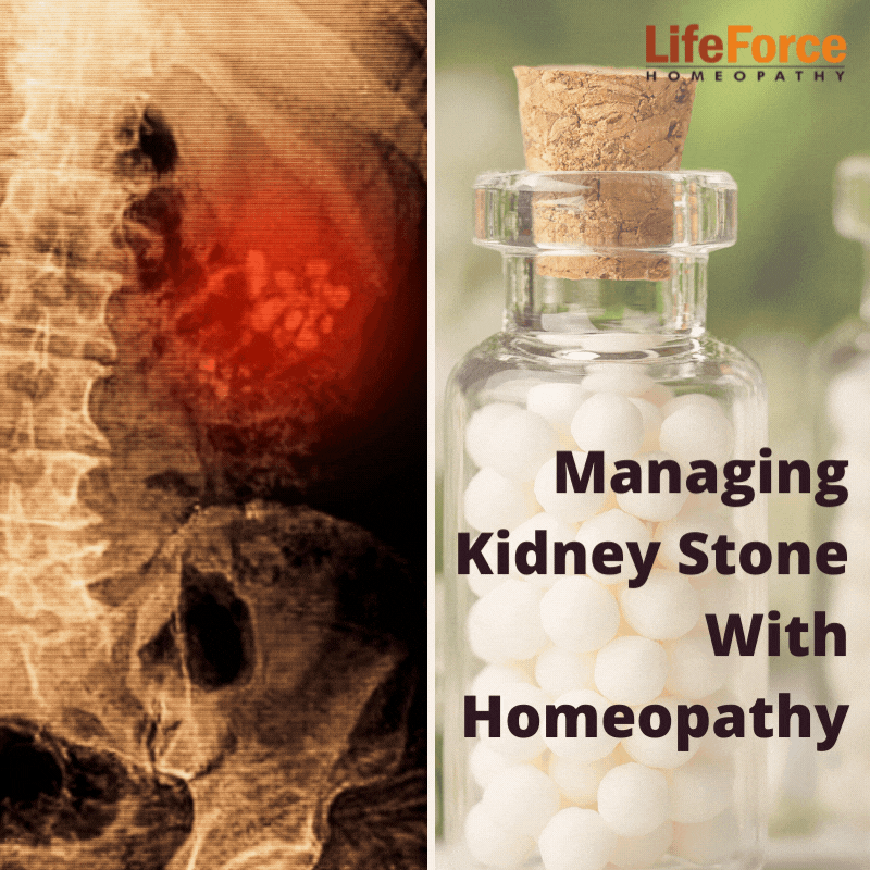 Manage Kidney Stone With Homeopathy
