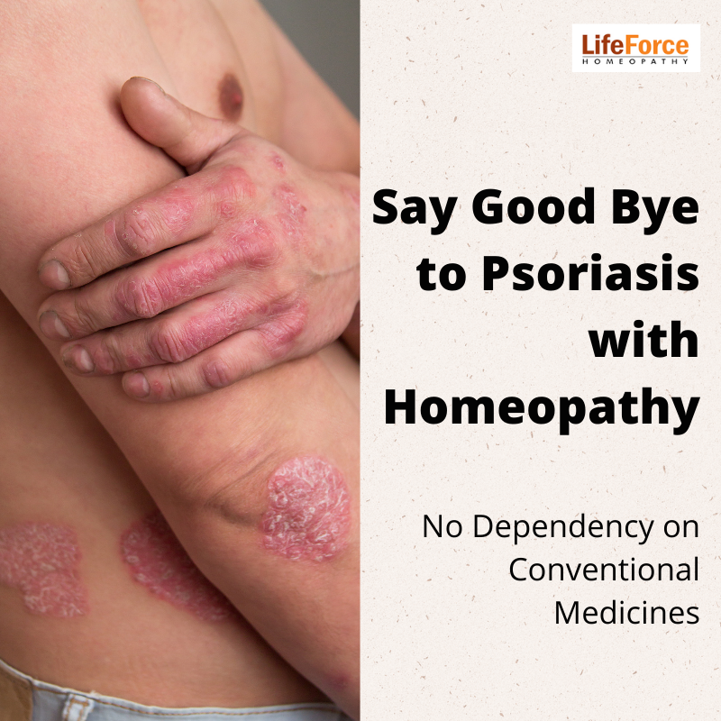 Homeopathy for Psoriasis