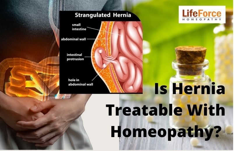 Is Hernia Treatable With Homeopathy?