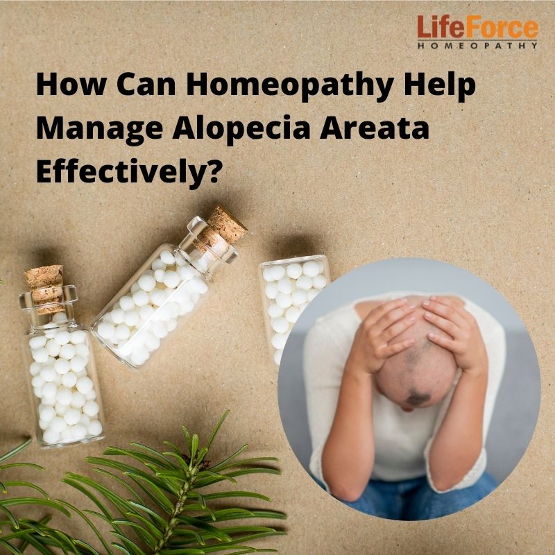 Homeopathy Help Manage Alopecia Areata