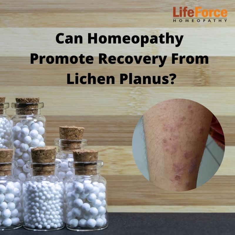 Can Homeopathy Promote Recovery From Lichen Planus?