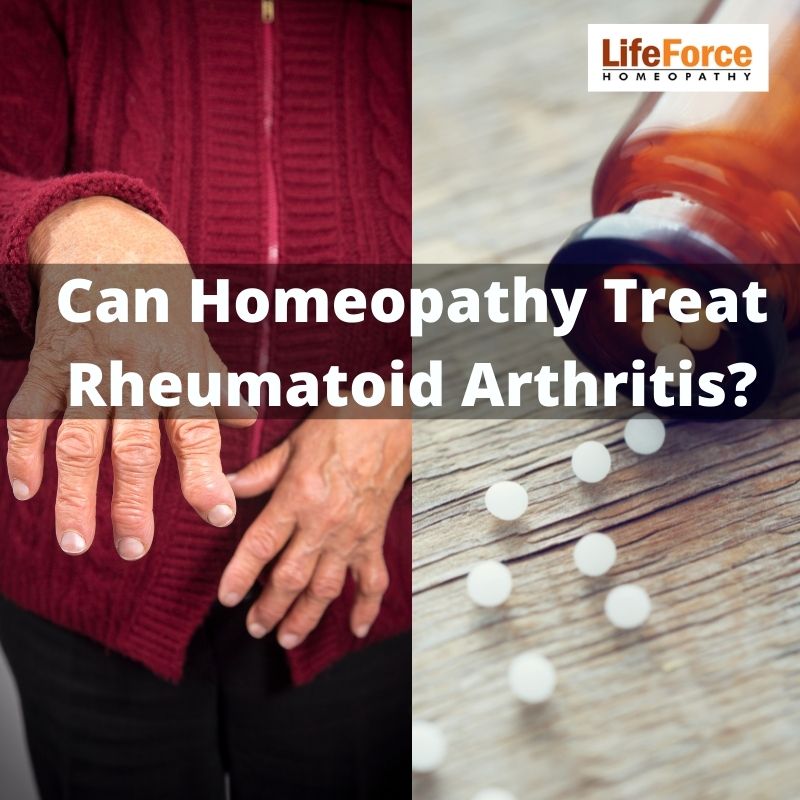 Can Homeopathy Treat Rheumatoid Arthritis?