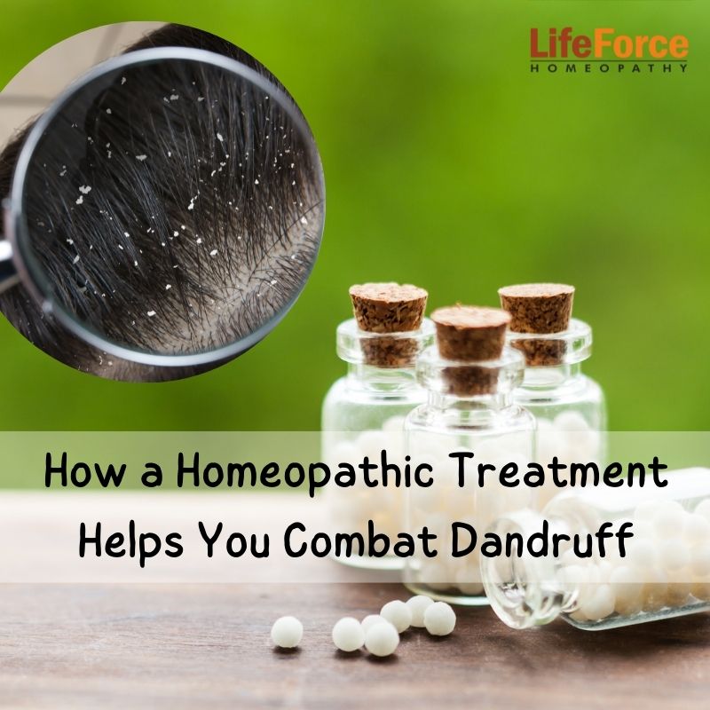 How Homeopathic Treatment Helps You Combat Dandruff Naturally?